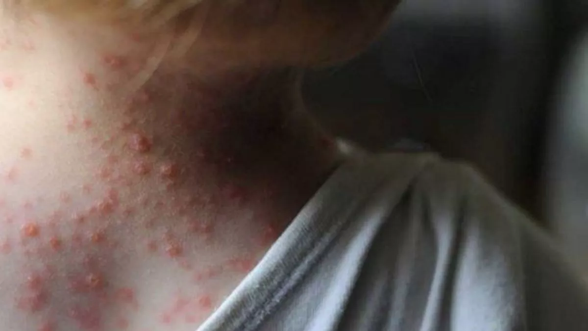 viruela-del-mono-2jpg