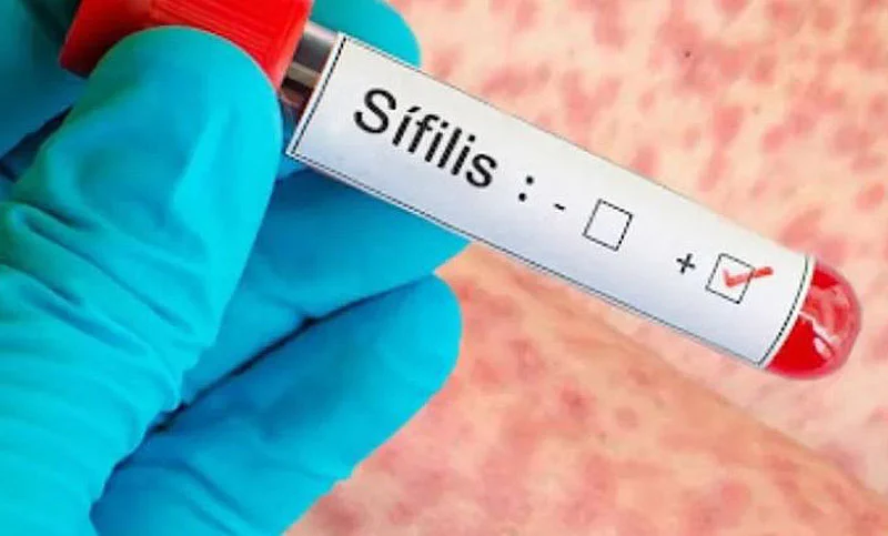 sifilis
